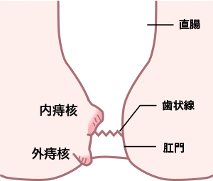 痔核イラスト