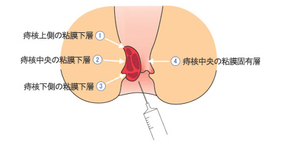 四段階注射法のイラスト図