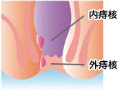 痔核（いぼ痔）のイラスト図