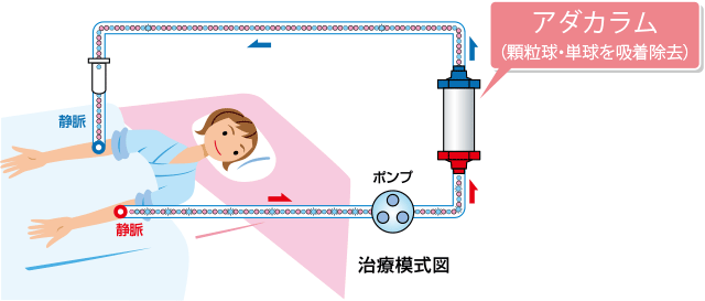 顆粒球吸着療法